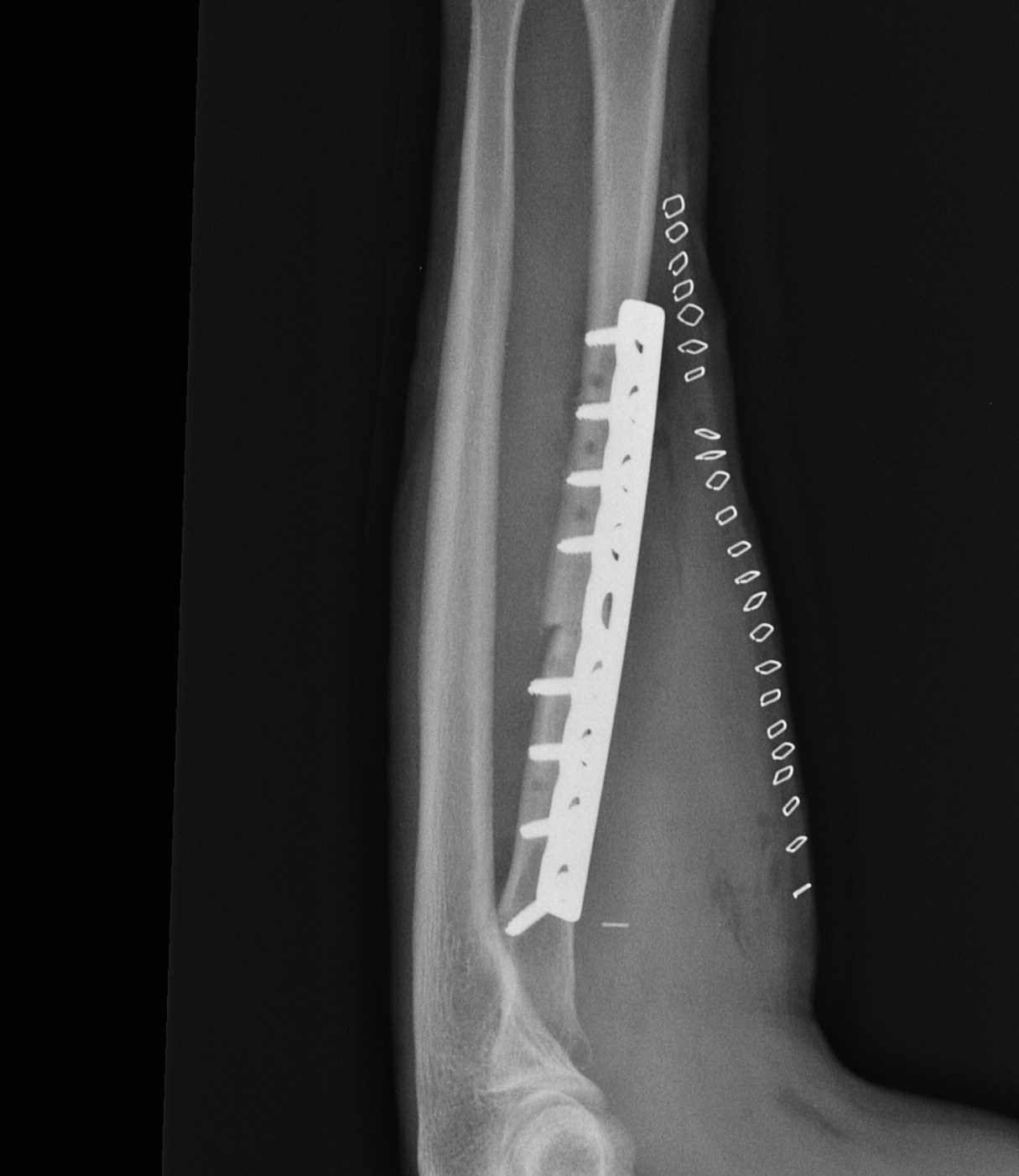 Radial Osteotomy Lateral